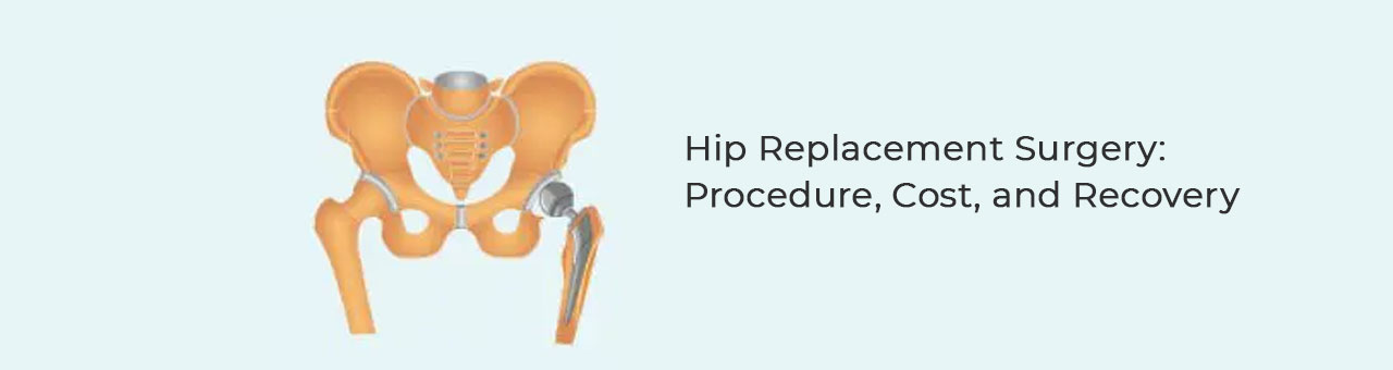 Hip Replacement Surgery: Procedure, Cost, and Recovery